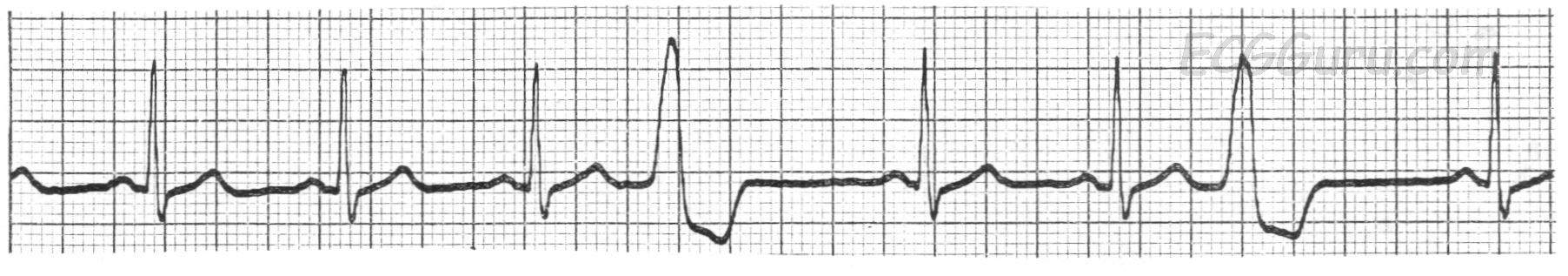 Premature Ventricular Contractions Ecg